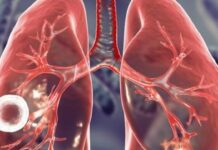 Тривожна статистика: Одещина у топі за туберкульозом