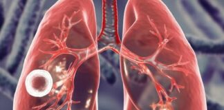 Тривожна статистика: Одещина у топі за туберкульозом