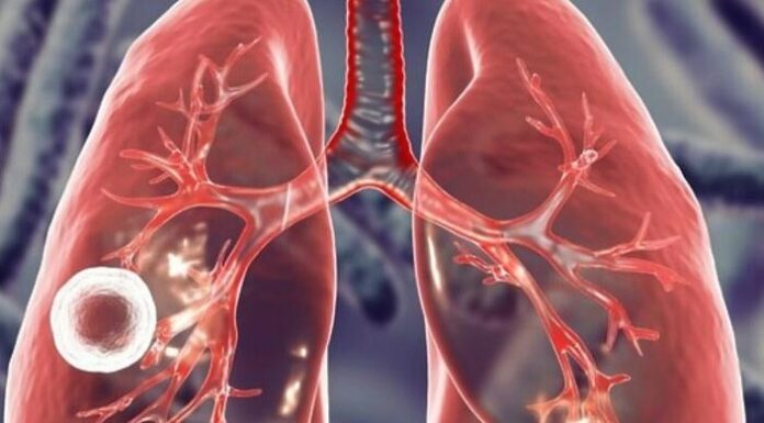 Тривожна статистика: Одещина у топі за туберкульозом