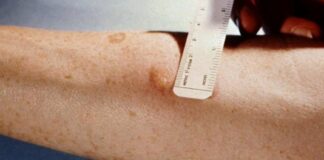 Без Манту: в Одесі запровадять нові тести на туберкульоз