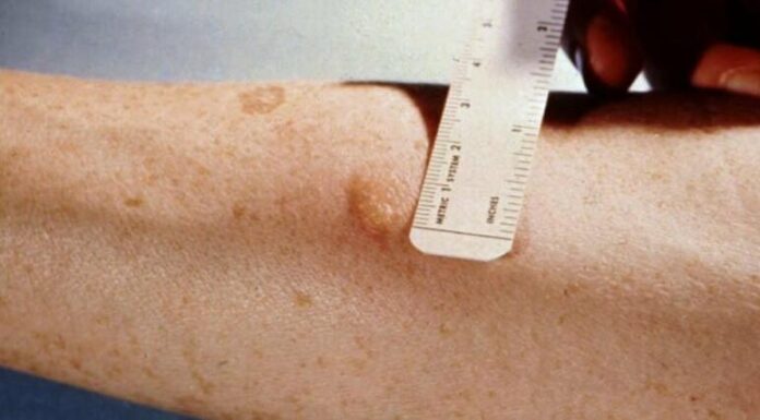 Без Манту: в Одесі запровадять нові тести на туберкульоз